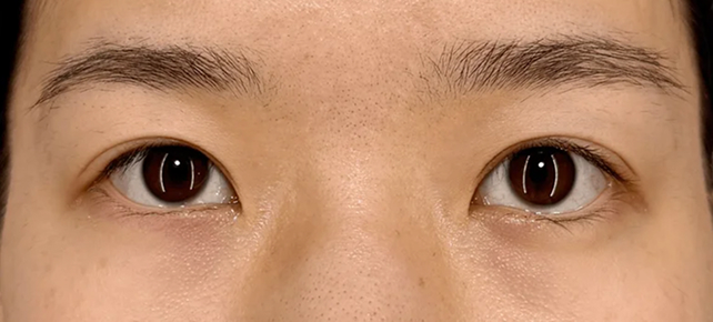 二重まぶた・全切開法,垂れ目（パンダ目）形成（グラマラスライン／下眼瞼下制術）,垂れ目（パンダ目）形成と二重まぶた・全切開法で吊り目を改善した症例写真,After（メイクなし）
（3ヶ月後）,ba_panda029_a01.jpg