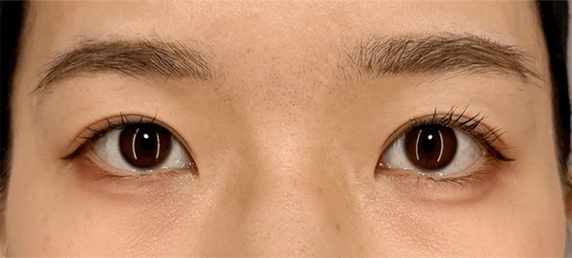 症例写真,垂れ目（パンダ目）形成と二重まぶた・全切開法で吊り目を改善した症例写真,After（メイクあり）<br/>
（3ヶ月後）,