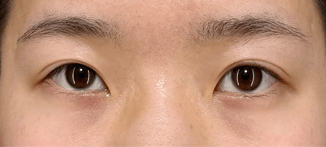 二重まぶた・全切開法,垂れ目（パンダ目）形成（グラマラスライン／下眼瞼下制術）,垂れ目（パンダ目）形成と二重まぶた・全切開法で吊り目を改善した症例写真,Before,ba_panda029_b01.jpg