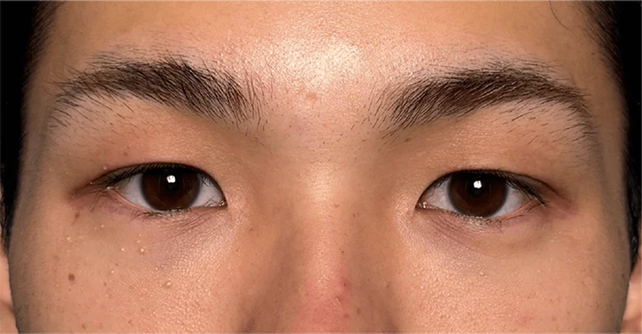 症例写真,二重まぶた・埋没法（一針固定）でまぶたの重みを改善し、自然な末広型二重にした症例写真,Before,ba_maibotsu101_b01.jpg
