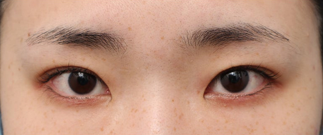 二重まぶた・埋没法（二針固定）で目の上の窪みも改善した20代女性の症例写真,After（メイクなし）
（3ヶ月後）,ba_maibotsu103_a01.jpg