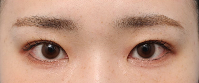 症例写真,二重まぶた・埋没法（二針固定）で目の上の窪みも改善した20代女性の症例写真,After（メイクあり）<br/>
（3ヶ月後）,