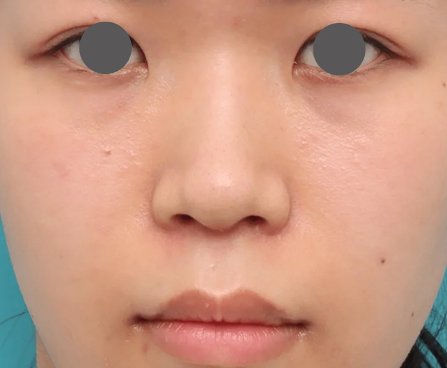 鼻翼縮小（小鼻縮小）,鼻翼縮小（小鼻縮小）で鼻の印象をさりげなく変えた症例写真,After（3ヶ月後）,ba_biyoku066_a01.jpg