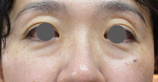 症例写真,スマイルアイリフトで目の下のクマとたるみを改善した症例,施術前,mainpic_smile_eye_lift001a.jpg