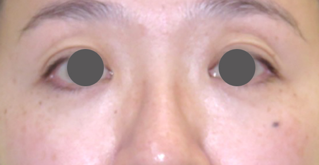 症例写真,スマイルアイリフトで目の下のクマとたるみを改善した症例,1回目照射後,mainpic_smile_eye_lift001b.jpg