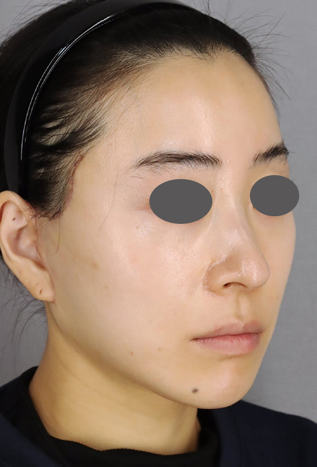 症例写真,ミディアムリフトでたるみを改善した症例写真,After（1ヶ月後）,ba_mediumlift033_b02.jpg