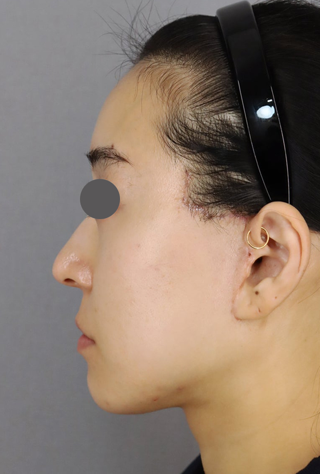 症例写真,ミディアムリフトでたるみを改善した症例写真,After（1ヶ月後）,ba_mediumlift033_b03.jpg