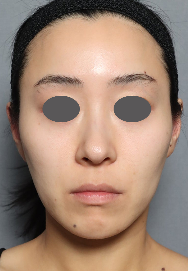 ミディアムフェイスリフト,ミディアムリフトでたるみを改善した症例写真,Before,ba_mediumlift033_b01.jpg