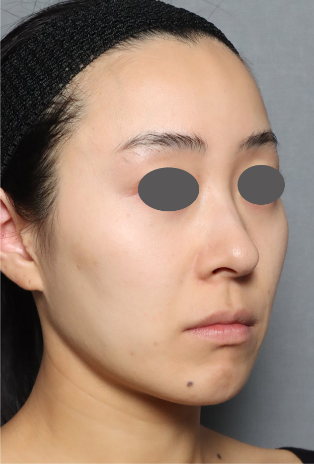 症例写真,ミディアムリフトでたるみを改善した症例写真,Before,ba_mediumlift033_b02.jpg