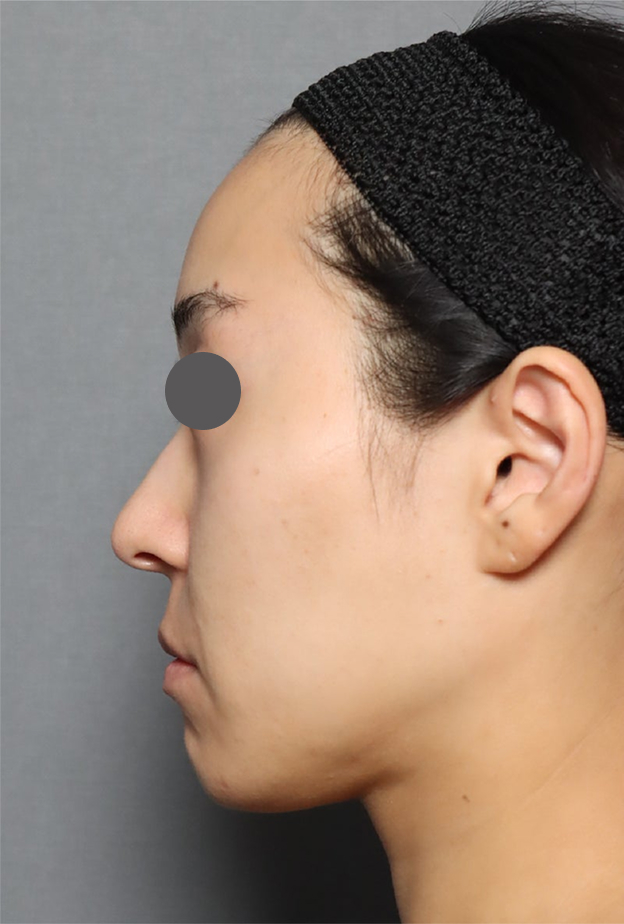 症例写真,ミディアムリフトでたるみを改善した症例写真,Before,ba_mediumlift033_b03.jpg