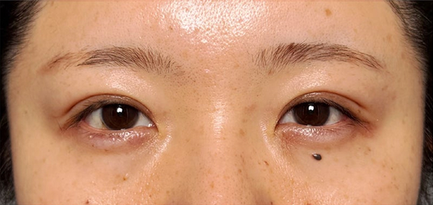 症例写真,二重まぶた・埋没法（二針固定）で末広型の奥二重から狭めのミックス型二重にした症例写真,After（1ヶ月後）,ba_maibotsu105_b01.jpg