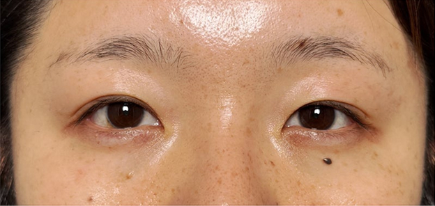 症例写真,二重まぶた・埋没法（二針固定）で末広型の奥二重から狭めのミックス型二重にした症例写真,Before,ba_maibotsu105_b01.jpg