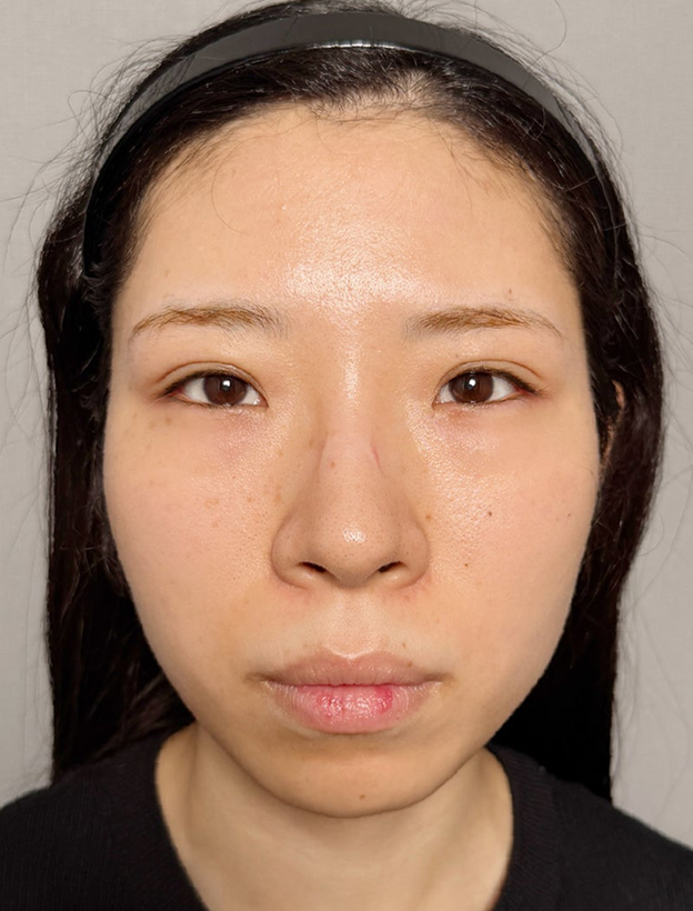 重たい一重まぶたを当日からメイクができる裏留め埋没法で平行型二重にした症例写真,After（1ヶ月後）,ba_maibotsu2016_a01.jpg