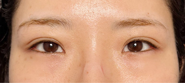 症例写真,重たい一重まぶたを当日からメイクができる裏留め埋没法で平行型二重にした症例写真,After（1ヶ月後）,ba_maibotsu2016_b02.jpg