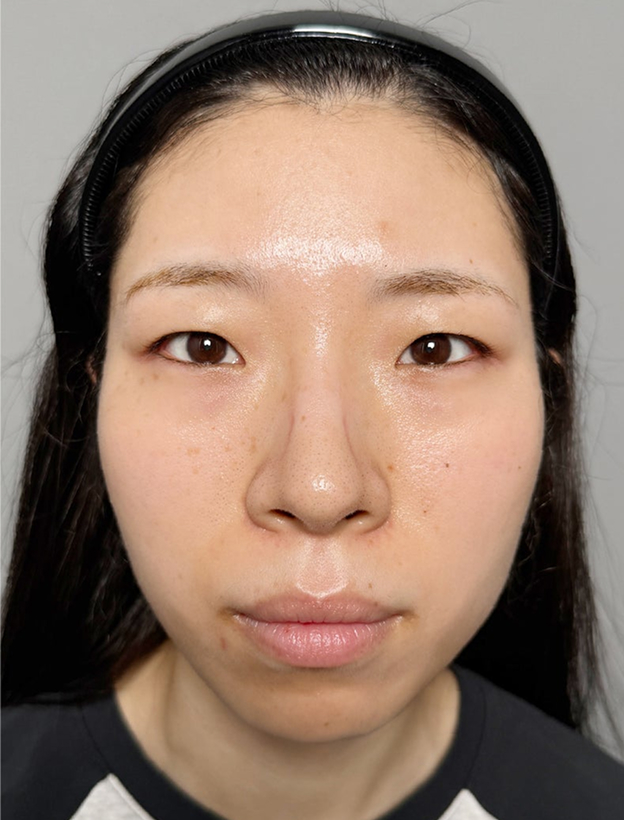 重たい一重まぶたを当日からメイクができる裏留め埋没法で平行型二重にした症例写真,Before,ba_maibotsu2016_b01.jpg