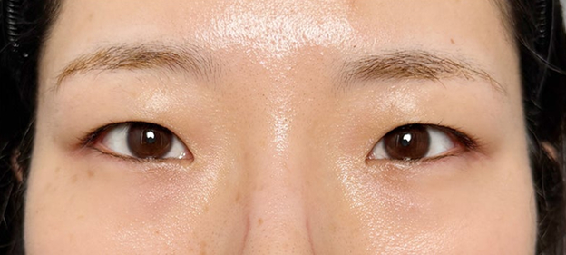 症例写真,重たい一重まぶたを当日からメイクができる裏留め埋没法で平行型二重にした症例写真,Before,ba_maibotsu2016_b02.jpg