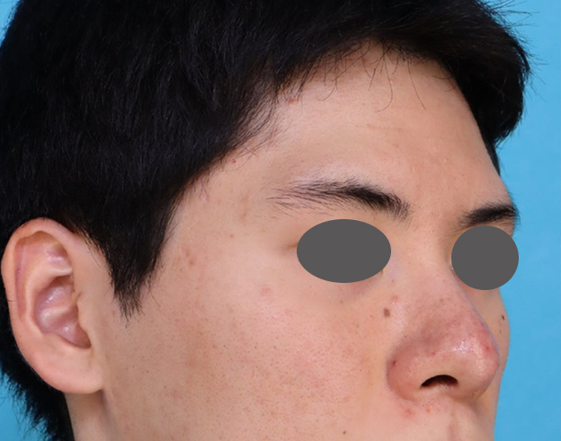 症例写真,耳介軟骨移植で鼻の高さや形を整えた症例写真,After（3ヶ月後）,ba_jikai065_b03.jpg