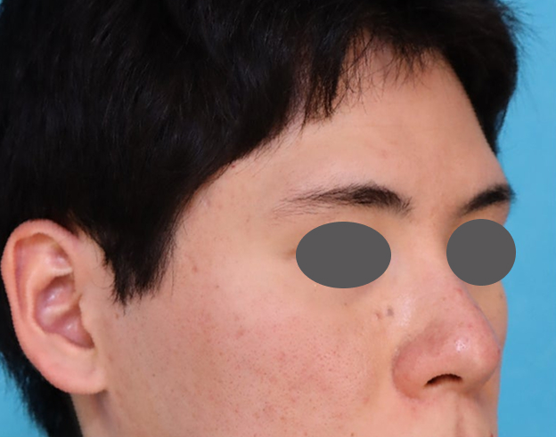 症例写真,耳介軟骨移植で鼻の高さや形を整えた症例写真,Before,ba_jikai065_b03.jpg