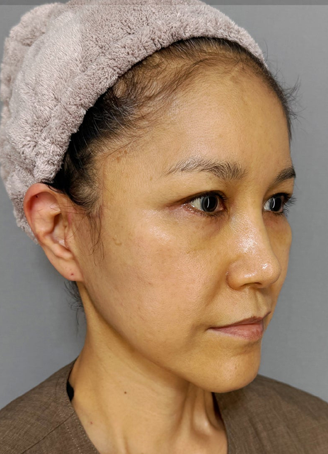 症例写真,ミディアムフェイスリフトで顔のたるみを改善した50代の患者様の症例写真,After（3ヶ月後）,ba_mediumlift034_b02.jpg