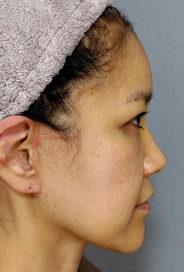 症例写真,ミディアムフェイスリフトで顔のたるみを改善した50代の患者様の症例写真,After（3ヶ月後）,ba_mediumlift034_b03.jpg