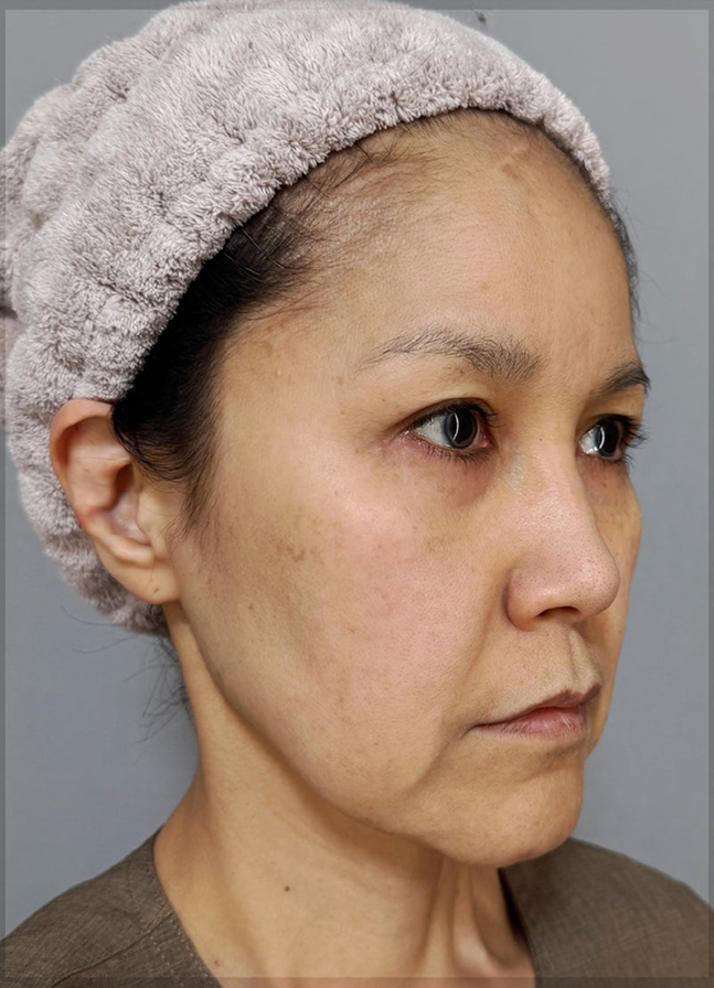 症例写真,ミディアムフェイスリフトで顔のたるみを改善した50代の患者様の症例写真,Before,ba_mediumlift034_b02.jpg