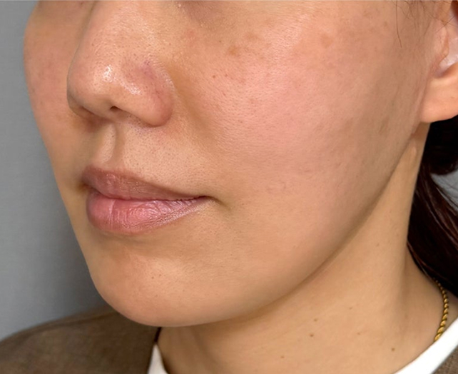 症例写真,ミディアムフェイスリフトで自然な美しさに見えるようにたるみを改善した40代女性の症例写真,After（3ヶ月後）,ba_mediumlift035_b02.jpg