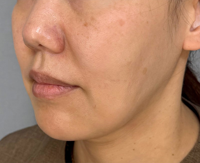 症例写真,ミディアムフェイスリフトで自然な美しさに見えるようにたるみを改善した40代女性の症例写真,Before,ba_mediumlift035_b02.jpg