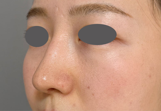 症例写真,わし鼻・段鼻修正,ハンプ切除+鼻のプロテーゼ抜き+耳介軟骨移植を行った症例写真,After（1ヶ月後）,ba_hump016_b02.jpg