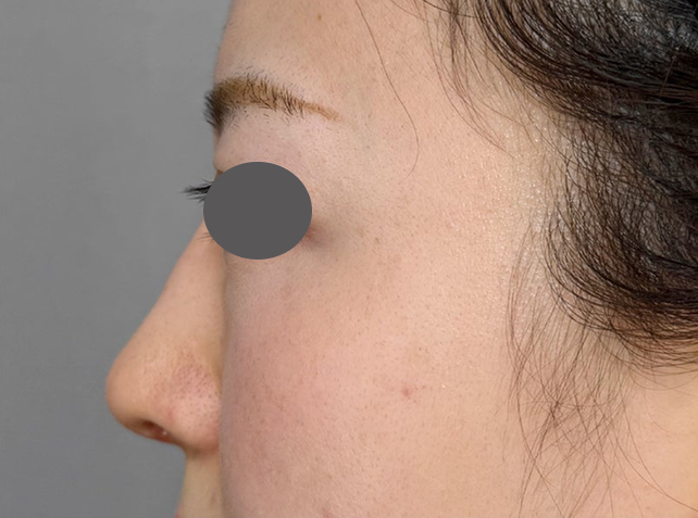 症例写真,わし鼻・段鼻修正,ハンプ切除+鼻のプロテーゼ抜き+耳介軟骨移植を行った症例写真,After（1ヶ月後）,ba_hump016_b03.jpg