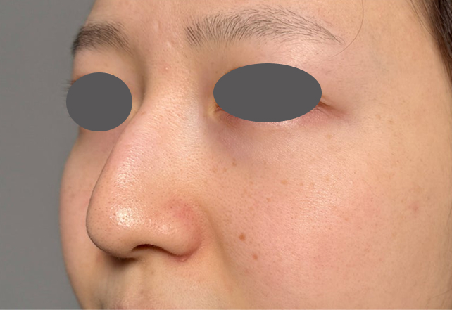 症例写真,わし鼻・段鼻修正,ハンプ切除+鼻のプロテーゼ抜き+耳介軟骨移植を行った症例写真,Before,ba_hump016_b02.jpg