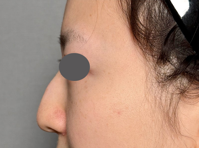 症例写真,わし鼻・段鼻修正,ハンプ切除+鼻のプロテーゼ抜き+耳介軟骨移植を行った症例写真,Before,ba_hump016_b03.jpg