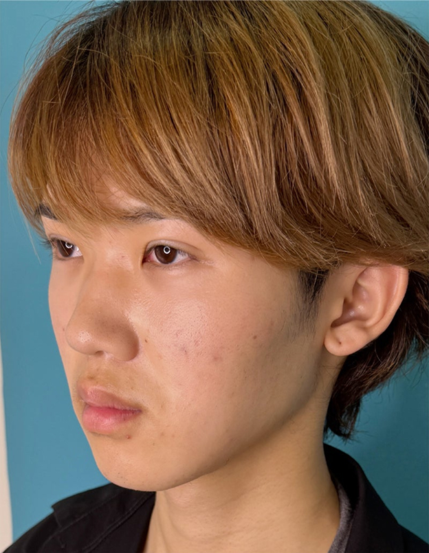 二重まぶた・連続埋没法,まぶたに負担が少ない二重まぶた・連続埋没法で二重を作った症例写真,After（1ヶ月後）,ba_maibotsu3007_a01.jpg
