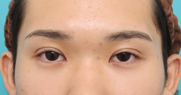 症例写真,まぶたに負担が少ない二重まぶた・連続埋没法で二重を作った症例写真,After（1ヶ月後）,ba_maibotsu3007_b02.jpg