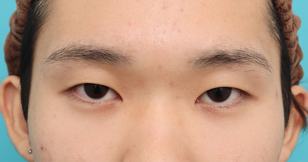 症例写真,まぶたに負担が少ない二重まぶた・連続埋没法で二重を作った症例写真,Before,ba_maibotsu3007_b02.jpg