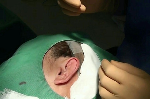 柔道耳 レッスルイヤー カリフラワー耳 修正手術キャプチャ 写真 解説 施術の流れを写真で解説 美容整形の高須クリニック