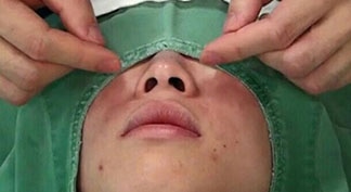 小鼻縮小手術（内側法）キャプチャ（写真）解説