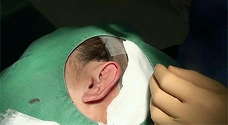 柔道耳（レッスルイヤー、カリフラワー耳）修正手術キャプチャ（写真）解説