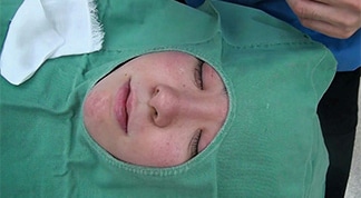 鼻尖縮小手術（団子鼻修正手術）+鼻先の耳介軟骨移植キャプチャ（写真）解説