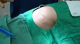 腰の入れ墨を切除縫縮手術で除去キャプチャ（写真）解説
