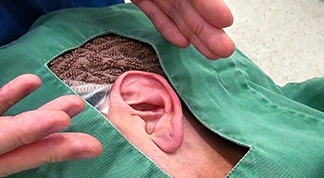 耳たぶ縮小手術(大きい福耳を小さくする)キャプチャ解説。