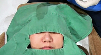 皮膚が厚く脂肪がついている団子鼻に対する小顔専用脂肪溶解注射メソシェイプフェイスキャプチャ（写真）解説