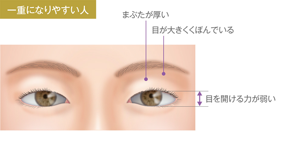 一重になりやすい人/まぶたが厚い、目が大きくくぼんでいる、目を開ける力が弱い