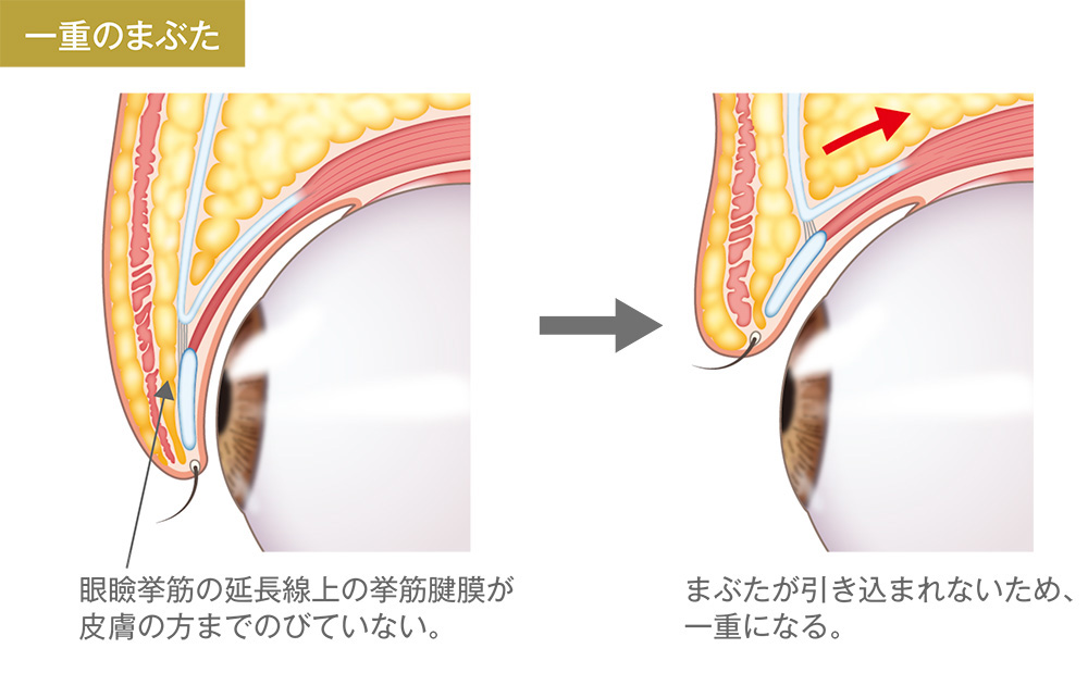 一重まぶた/眼瞼挙筋の延長線上の挙筋腱膜が皮膚の方までのびている。→まぶたが引き込まれて折れ、二重になる。