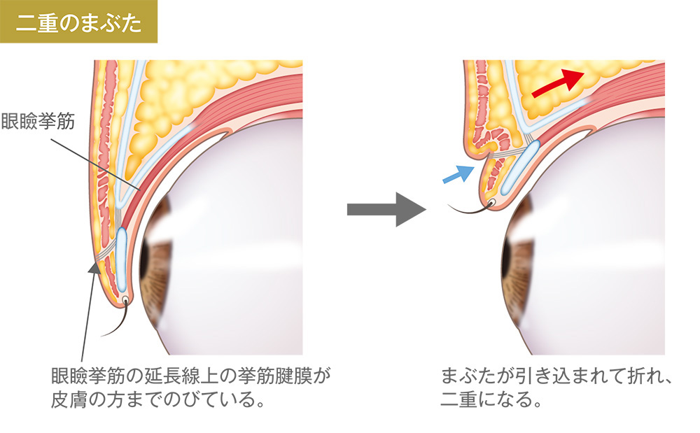 二重まぶた/眼瞼挙筋の延長線上の挙筋腱膜が皮膚の方までのびていない。→まぶたが引き込まれないため、一重になる。