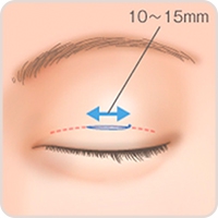 二重まぶた・埋没法