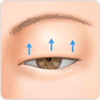 眼瞼下垂(デカ目整形)