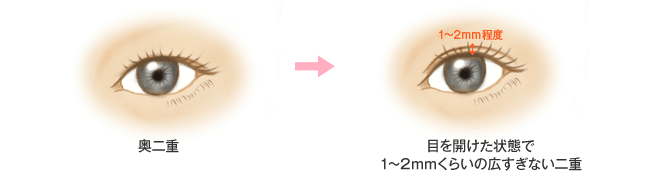 奥二重　目を開けた状態で1～2mmくらいの広すぎない二重