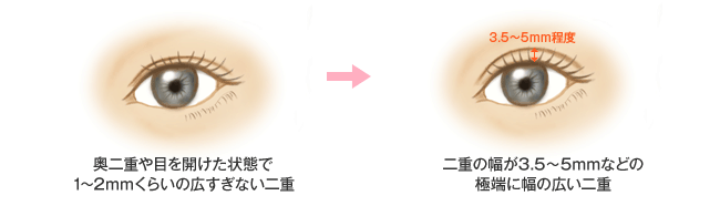 奥二重や目を開けた状態で1～2mmくらいの広すぎない二重　二重の幅が3.5～5mmなどの極端に幅の広い二重