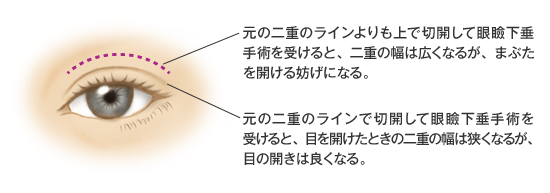 二重の人がその二重ラインで切開して眼瞼下垂手術をすると 目を開けたときの二重の幅は狭くなります Dr 高須幹弥の美容整形講座 美容整形の高須クリニック