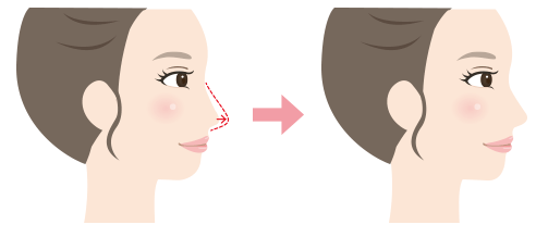 耳介軟骨移植をすると 団子鼻は治るのか 鼻先が細く尖るのか 鼻尖形成 鼻尖縮小 との違いは Dr 高須幹弥の美容整形講座 美容整形の高須クリニック